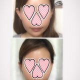 【韓国美容医療】韓国で糸リフトをして１か月経ちました～【体験レポート】